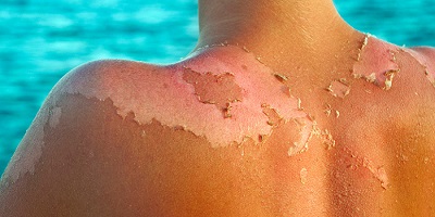 People Have Blamed Banana Boat Sunscreen For Their “Horrific” Burns
